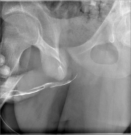 Fluoroscopy - retrograde urethrogram